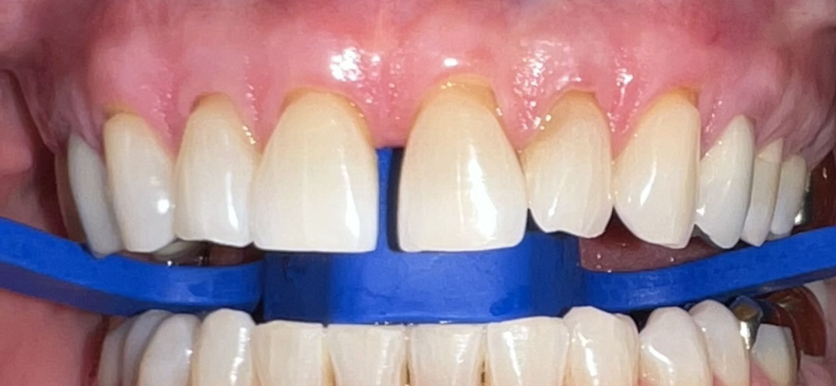 A close up of a person 's teeth with a blue rubber band around them.