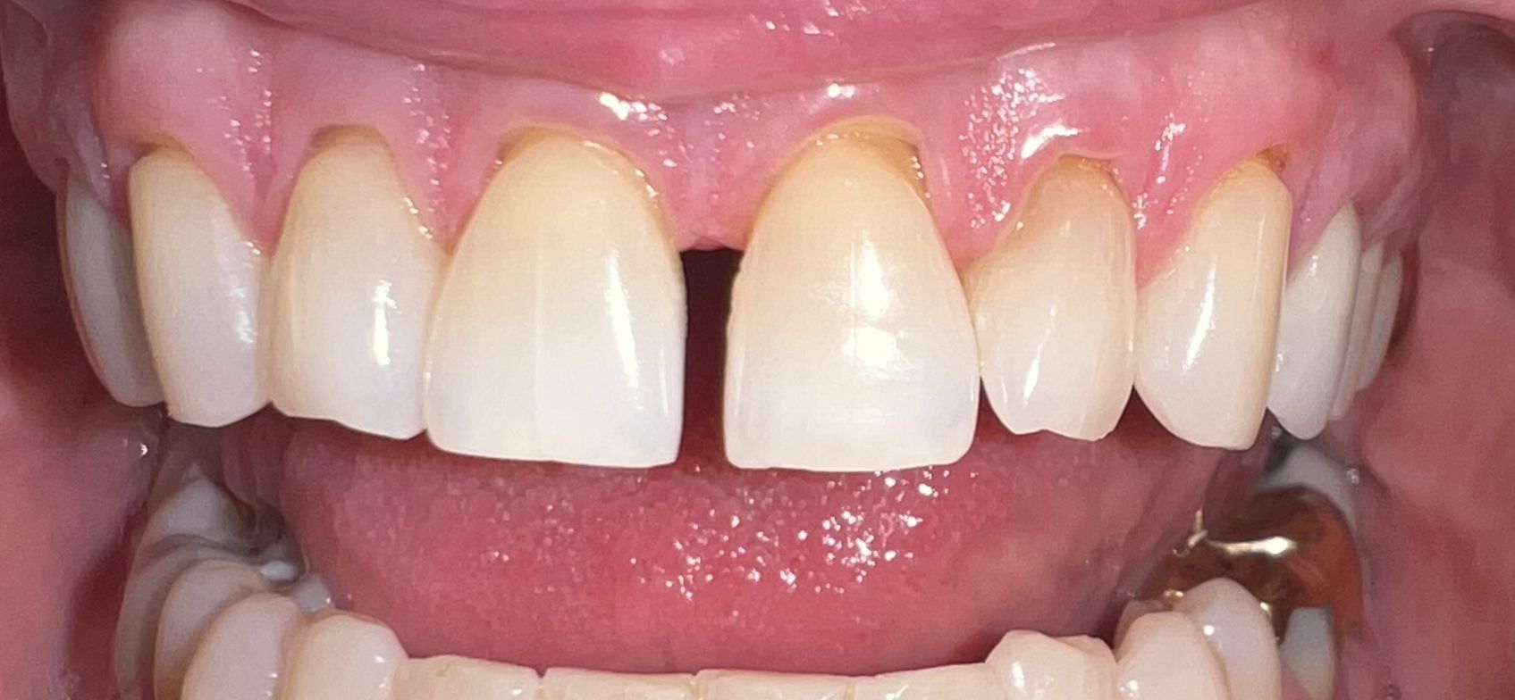 A close up of a person 's teeth with a missing tooth.