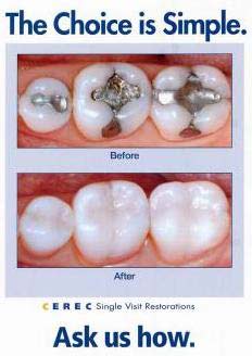 Cerec — Before and After Restorations in Wilmington, NC