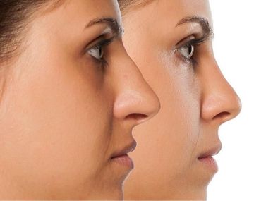 Intervento di addominoplastica