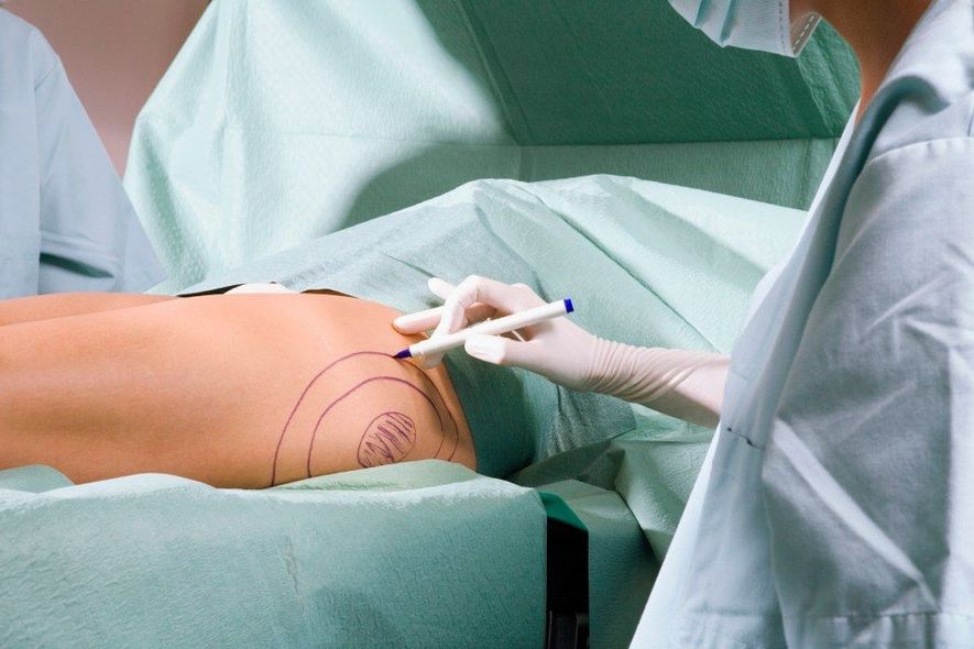 Donna per chirurgia estetica