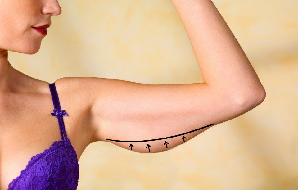 Aesthetic arm surgery treatment