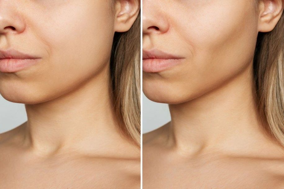 Before and after face filler