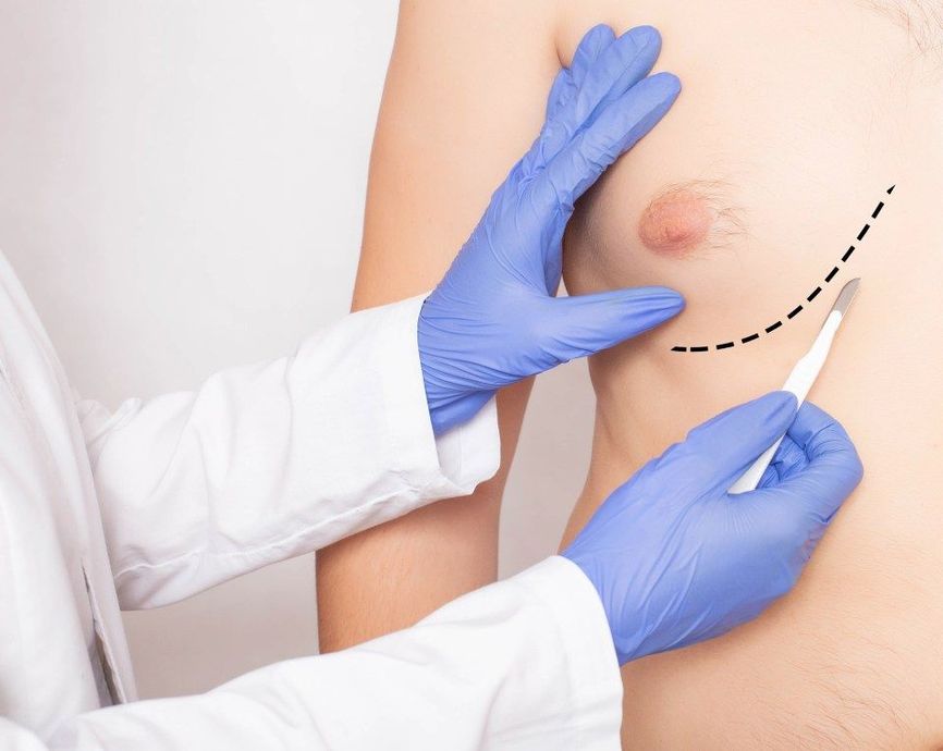 Gynecomastia surgery for men