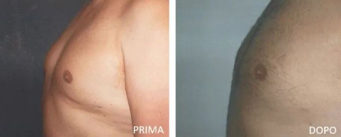Before and after gynaecomastia