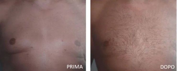 Before and after macro-gynaecomastia