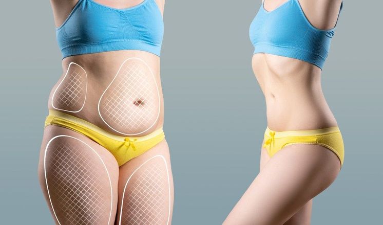 Interventi professionali di lipoaspirazione