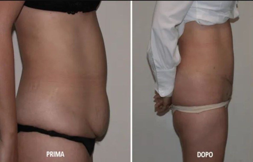 Before and after liposcuplture