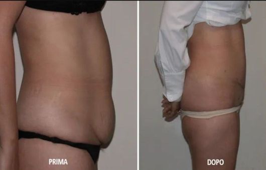 Liposcultura prima e dopo