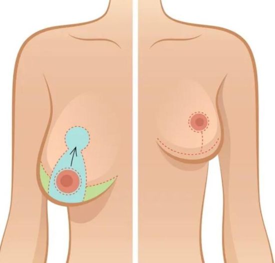 Breast ptosis correction
