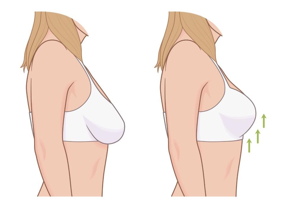 Droopy breast correction