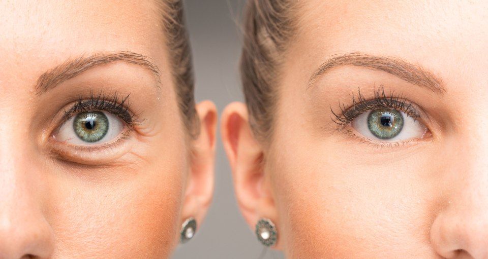 Before and after blepharoplasty