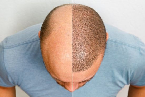 Before and after hair transplantation