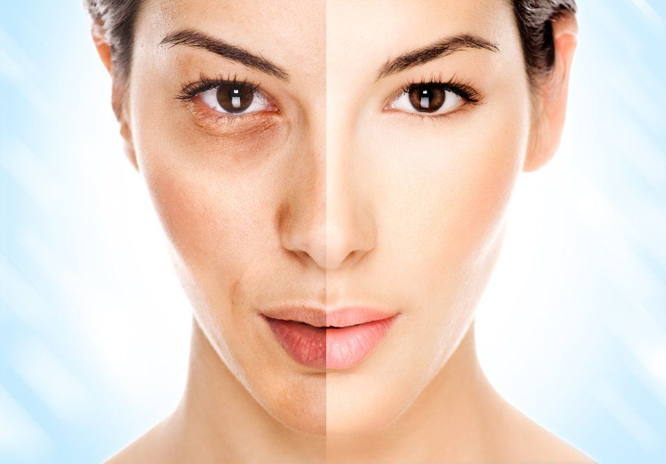 Before and after laser facial treatment