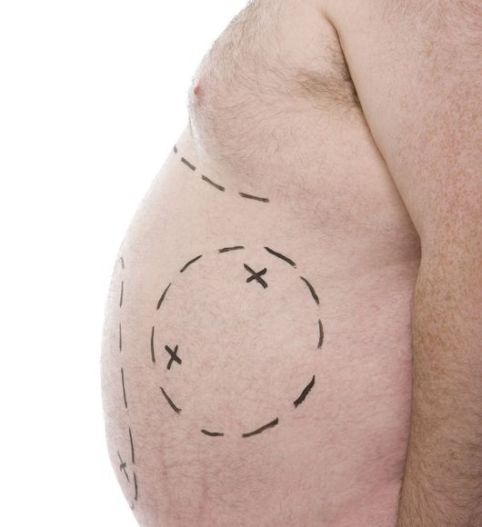 Rimozione precisa di adiposità localizzate