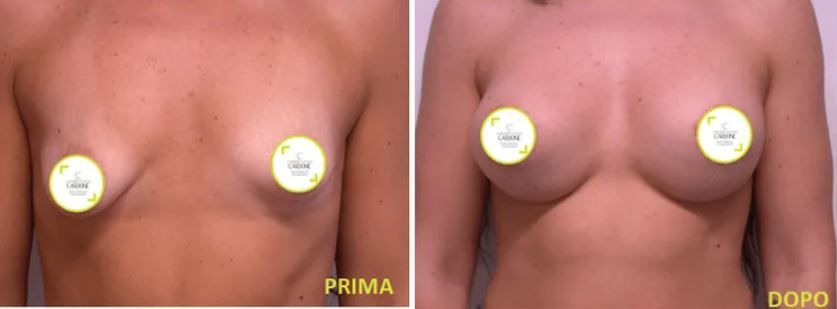 Mastoplastica additiva e riduttiva