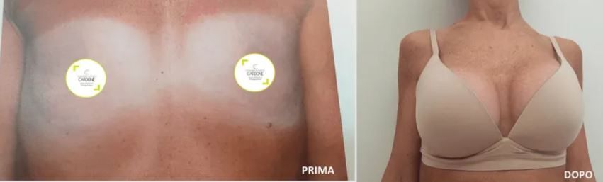 Mastoplastica additiva e riduttiva