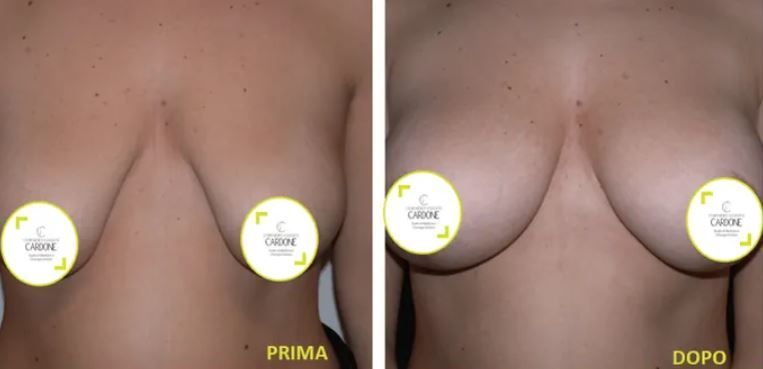 Mastoplastica additiva e riduttiva