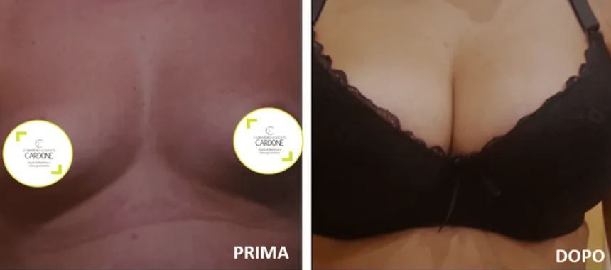 Mastoplastica additiva e riduttiva