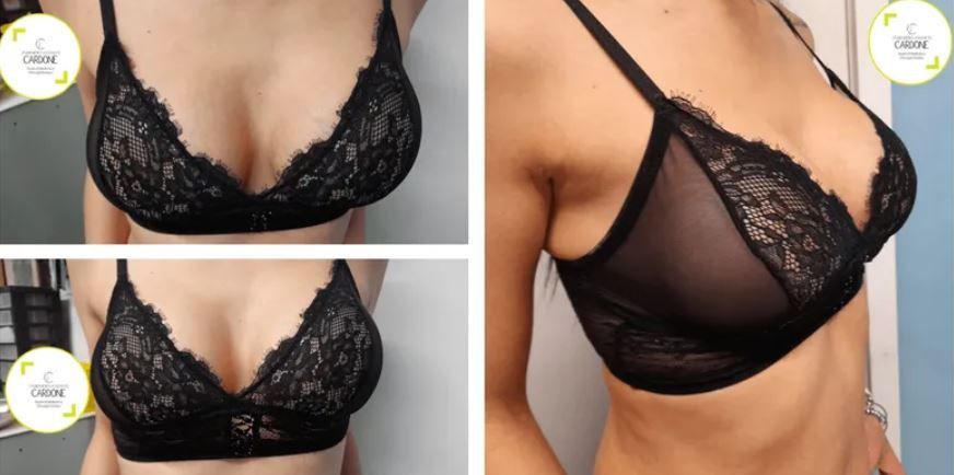 Mastoplastica additiva e riduttiva