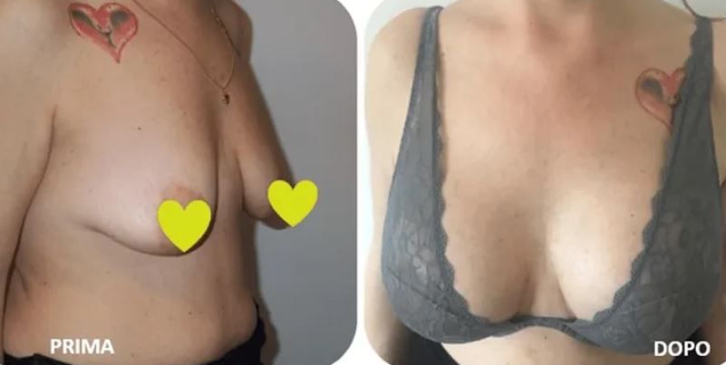 Mastoplastica additiva e riduttiva