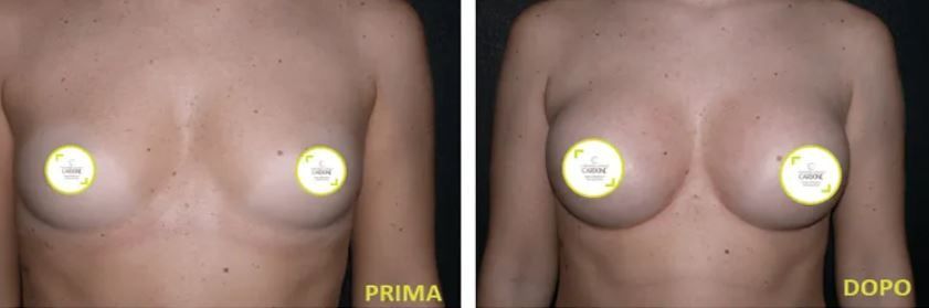 Mastoplastica additiva e riduttiva