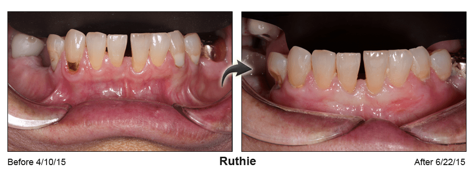 A before and after picture of a person 's teeth.