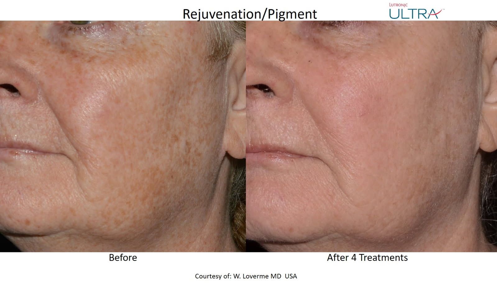 A before and after photo of a woman 's face.