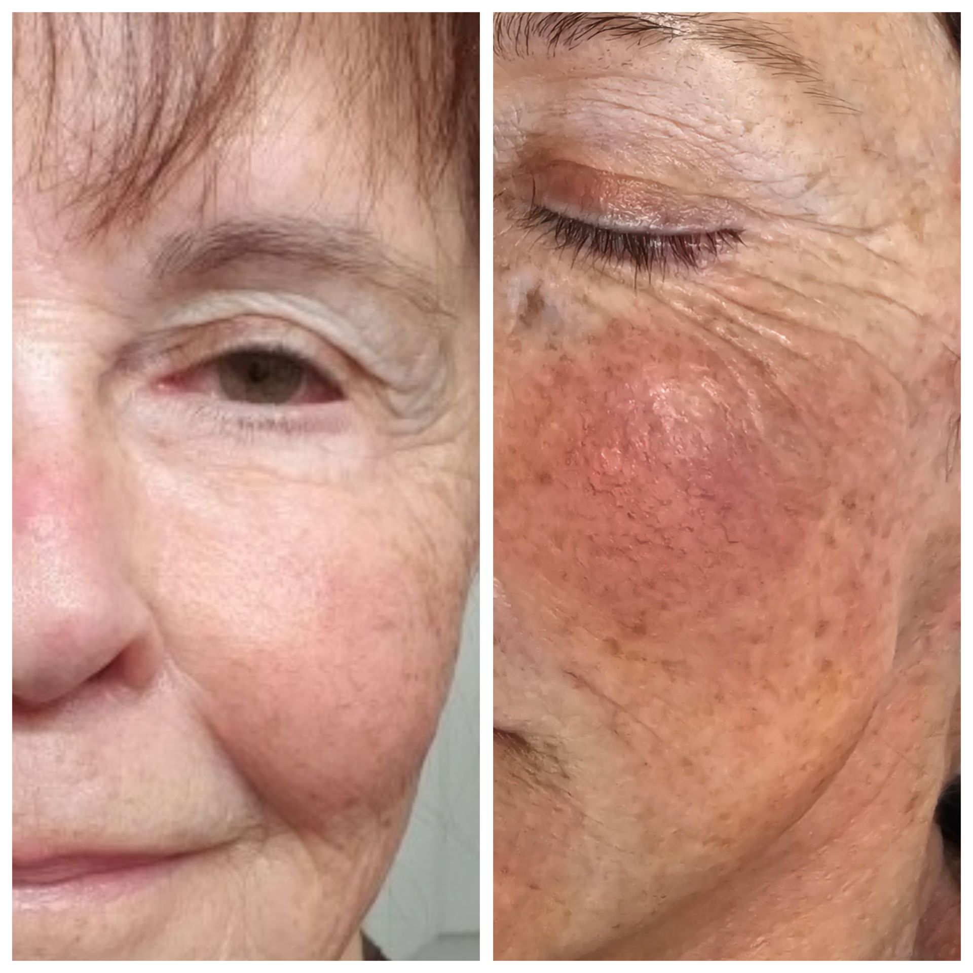 A woman 's face is shown before and after a treatment.