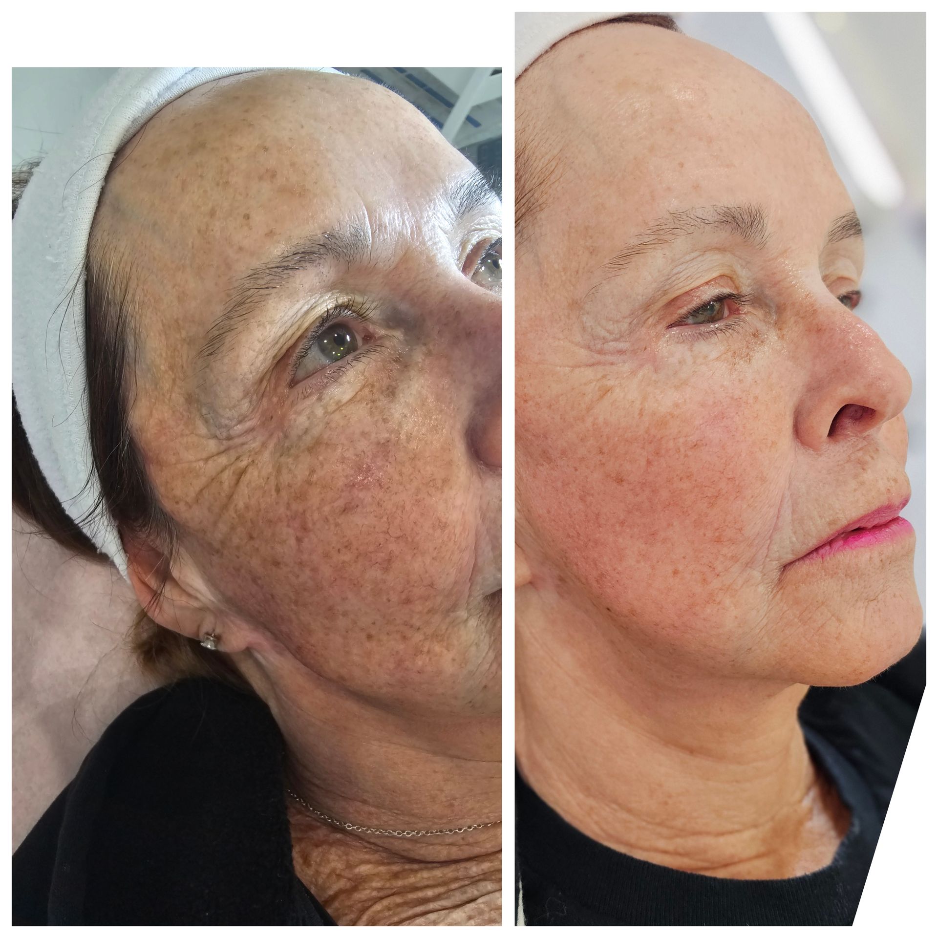 A before and after photo of a woman 's face.