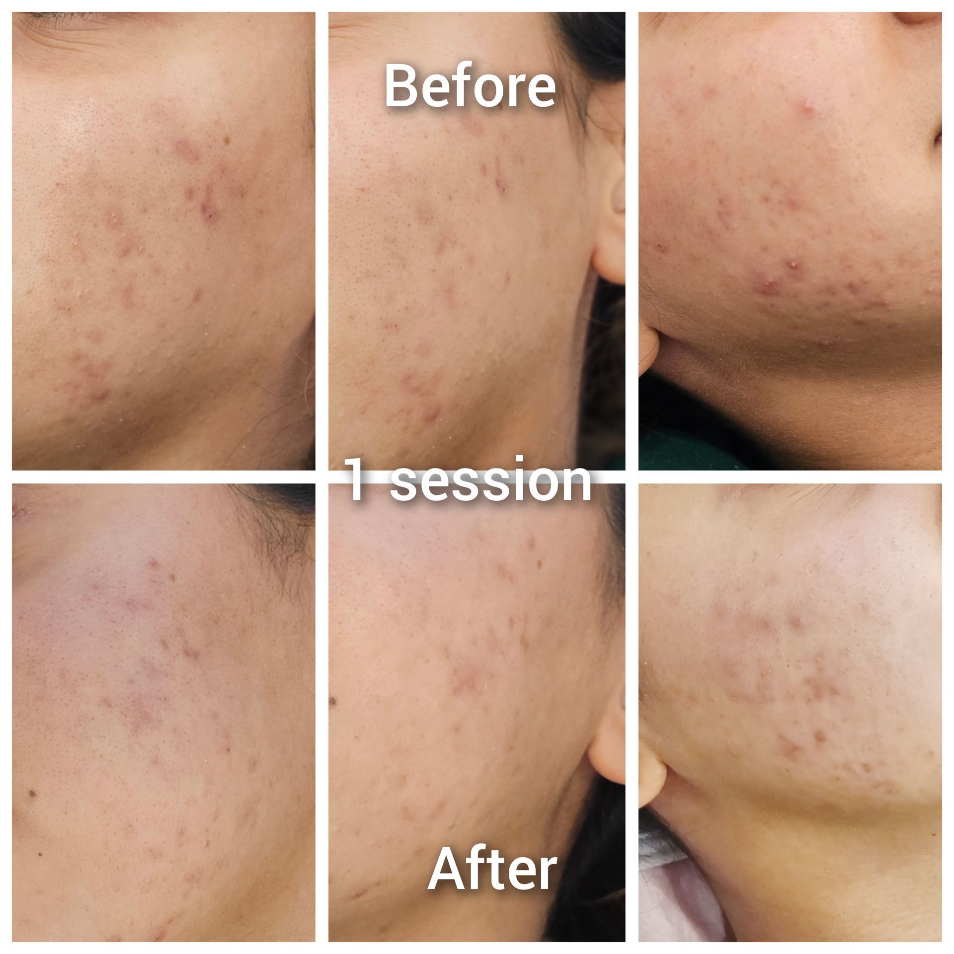 A before and after photo of a woman 's face with acne