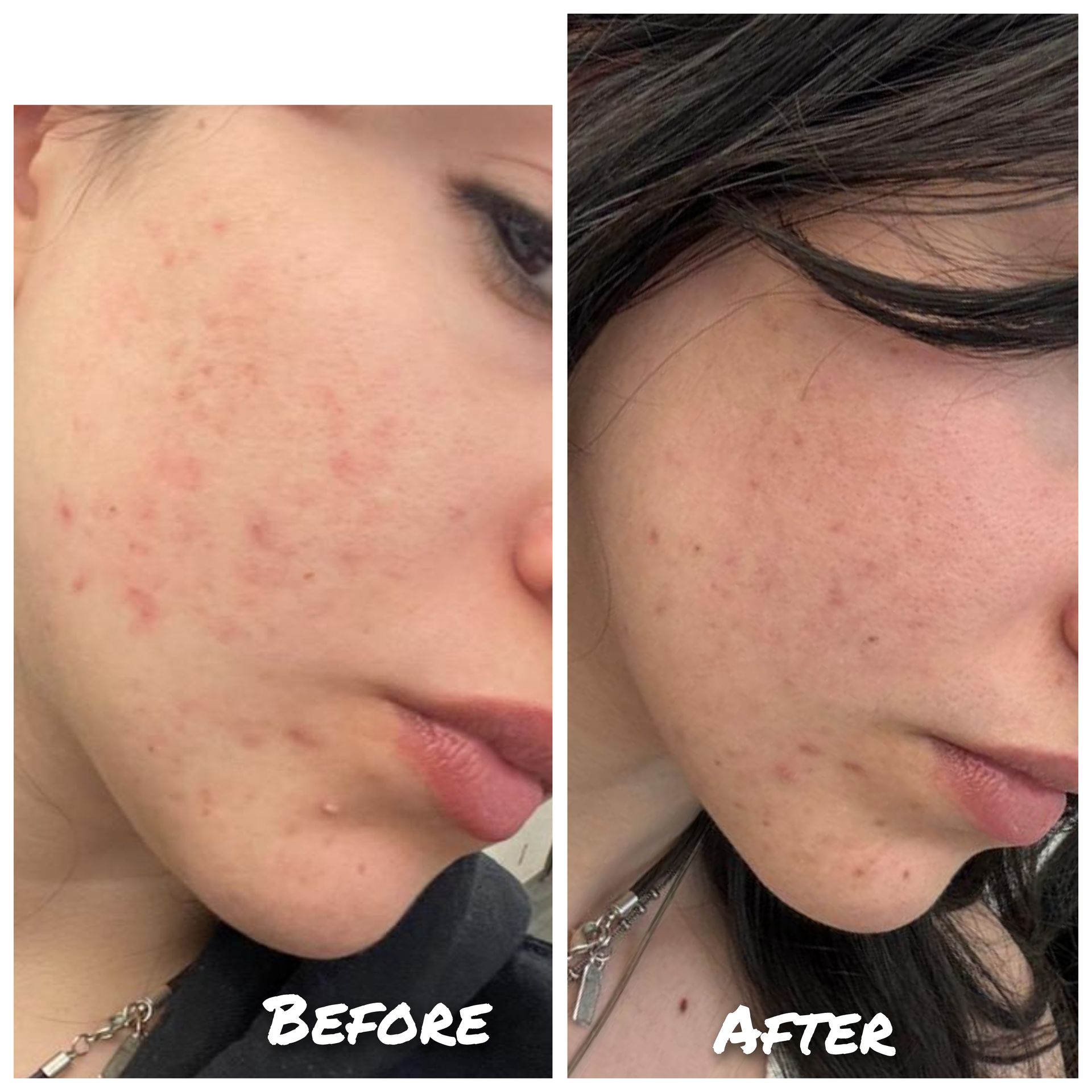 A before and after photo of a woman 's face with acne.