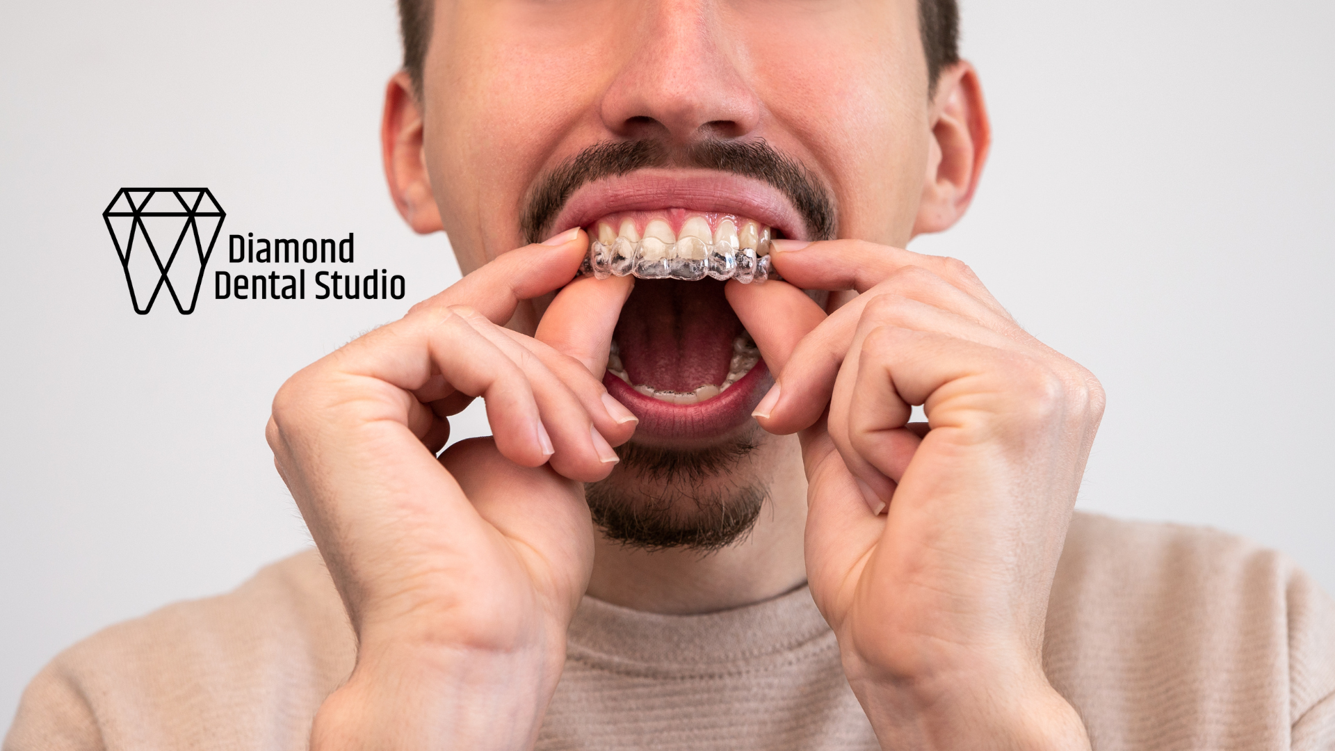 How to Make the Most of Your Clear Aligner Experience