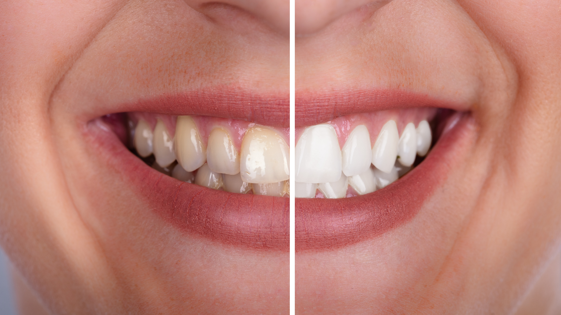 Split view of a smiling person's teeth: left side yellowed, right side bright white, showing before-and-after teeth whitening.