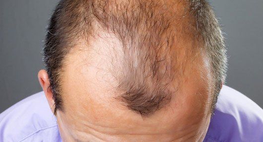 Male pattern baldness