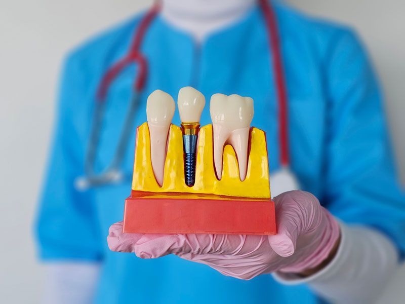 During consultation, a dentist demonstrates dental implants and crown models in a clinical setting.