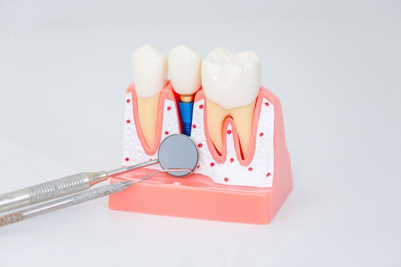Dental implant, artificial tooth roots into jaw, root canal of dental treatment, gum disease, teeth 