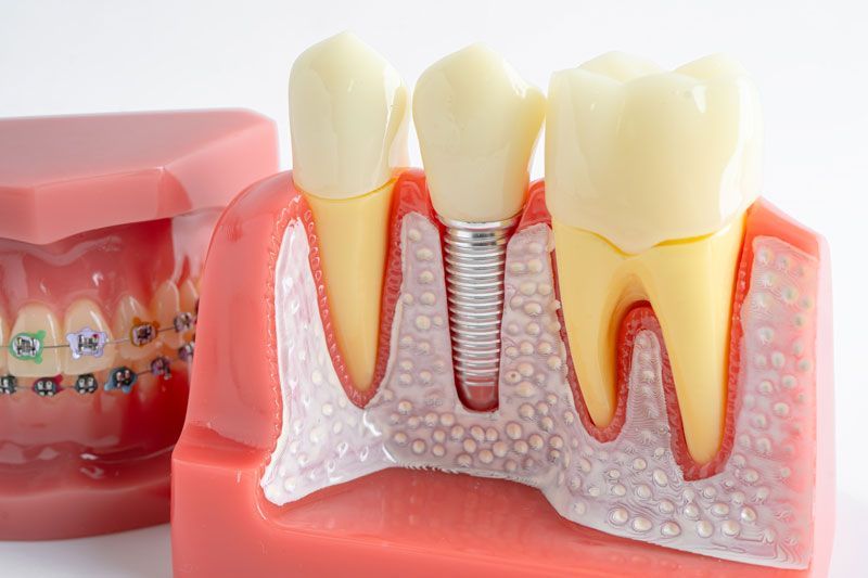 Dental implant, artificial tooth roots into jaw, root canal of dental treatment, gum disease, teeth 