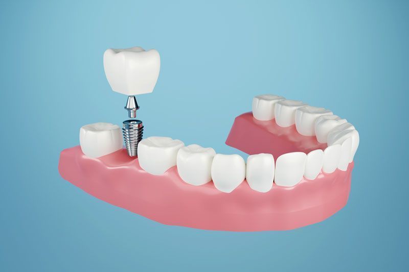a dental implant, showing the post, abutment, and crown going into jawbone against a blue backdrop.