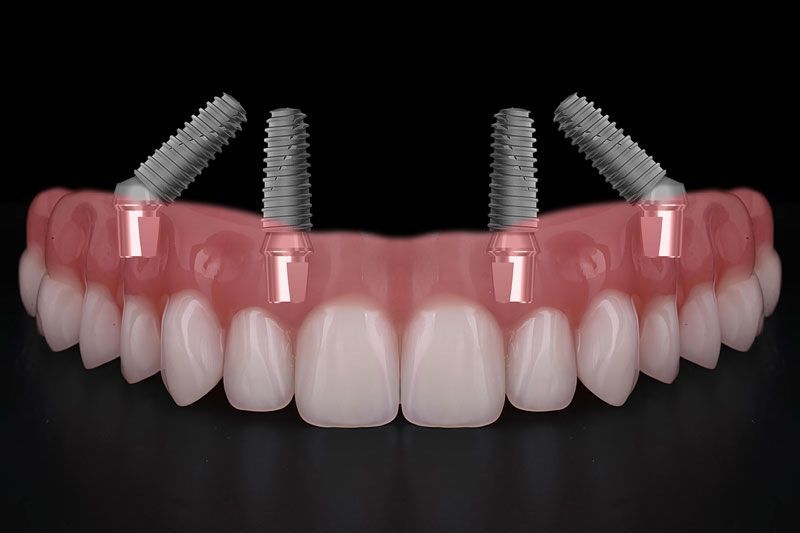 a full arch of teeth with 4 dental implants attached to them