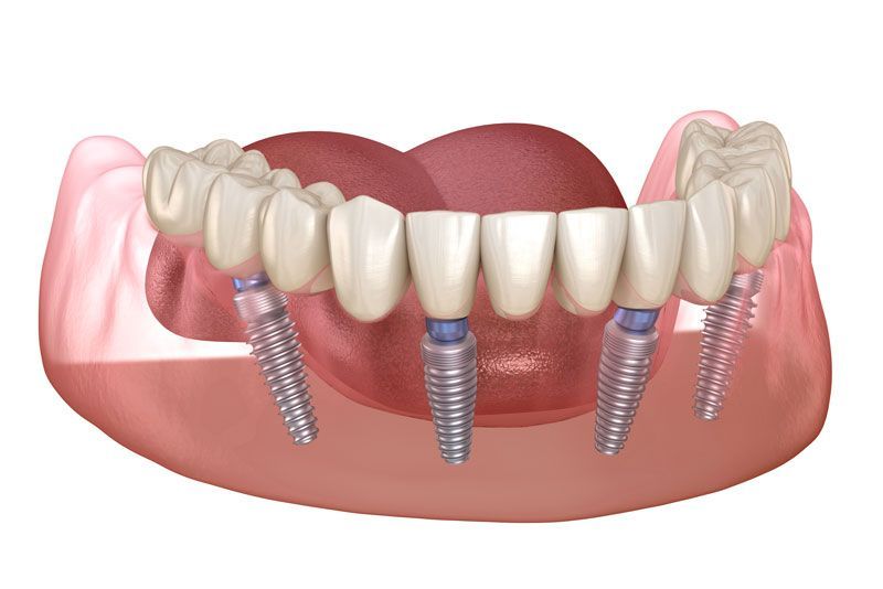 a all-on-4 dental implant model where four dental implant posts are securing a prosthesis in place.