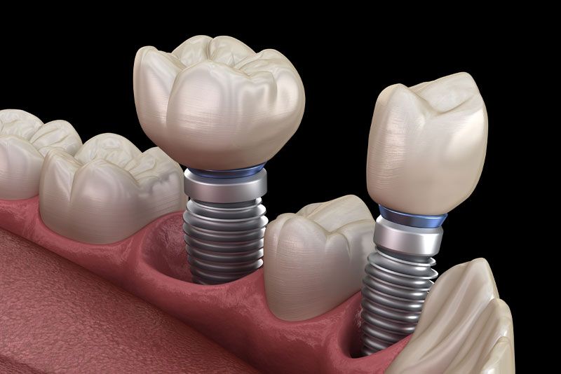 Two Single Dental Implants In A Patient's Mouth Graphic