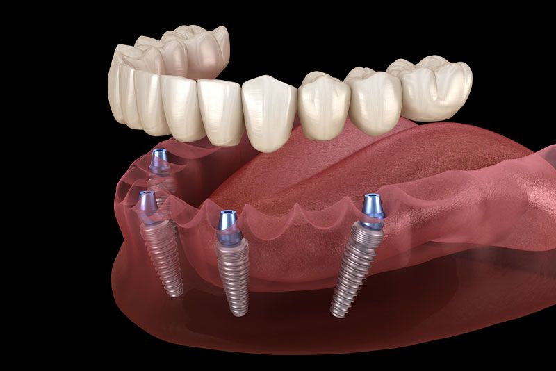 Zirconium Prosthesis Hovering Above 4 Dental Implants Graphic