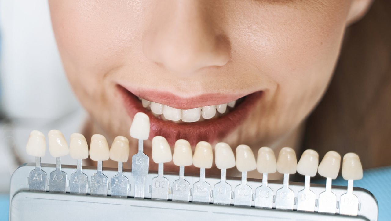 Tooth Colored Fillings