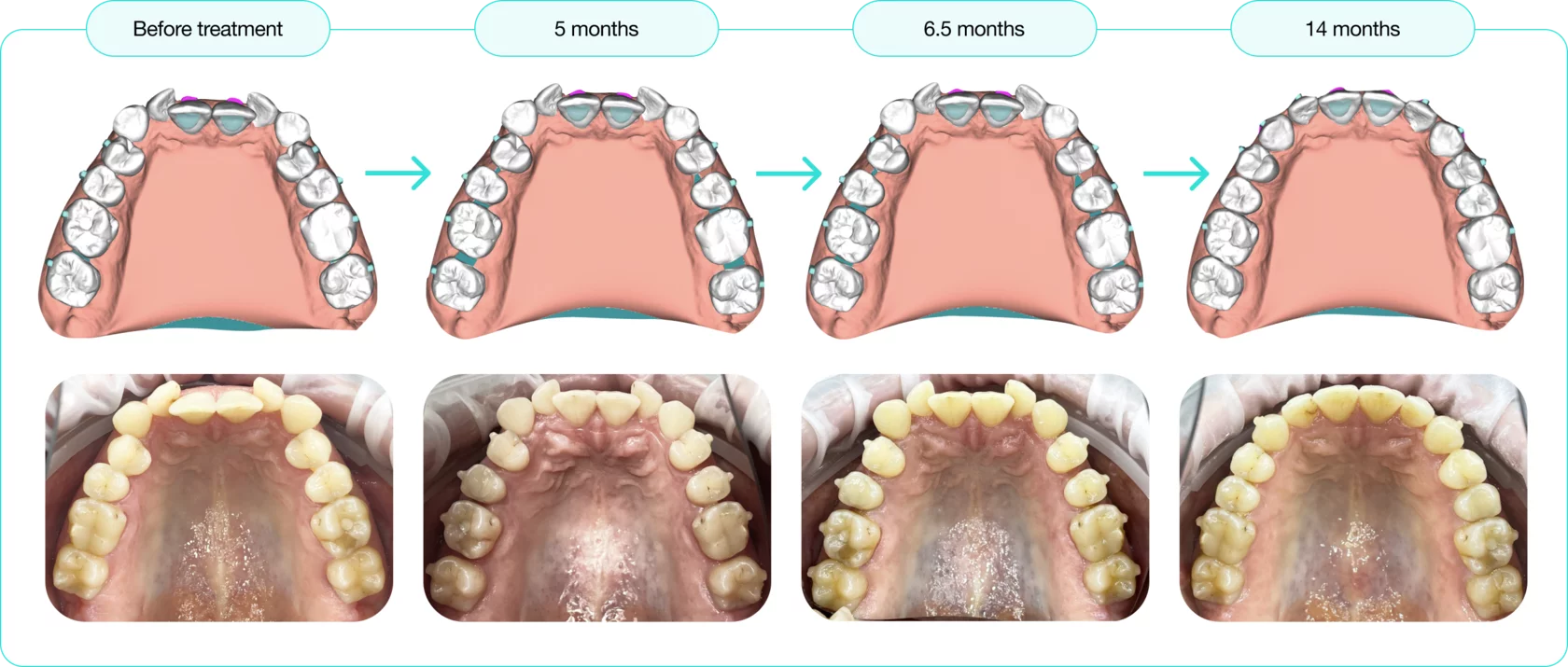 A picture of a person 's teeth with braces on them.