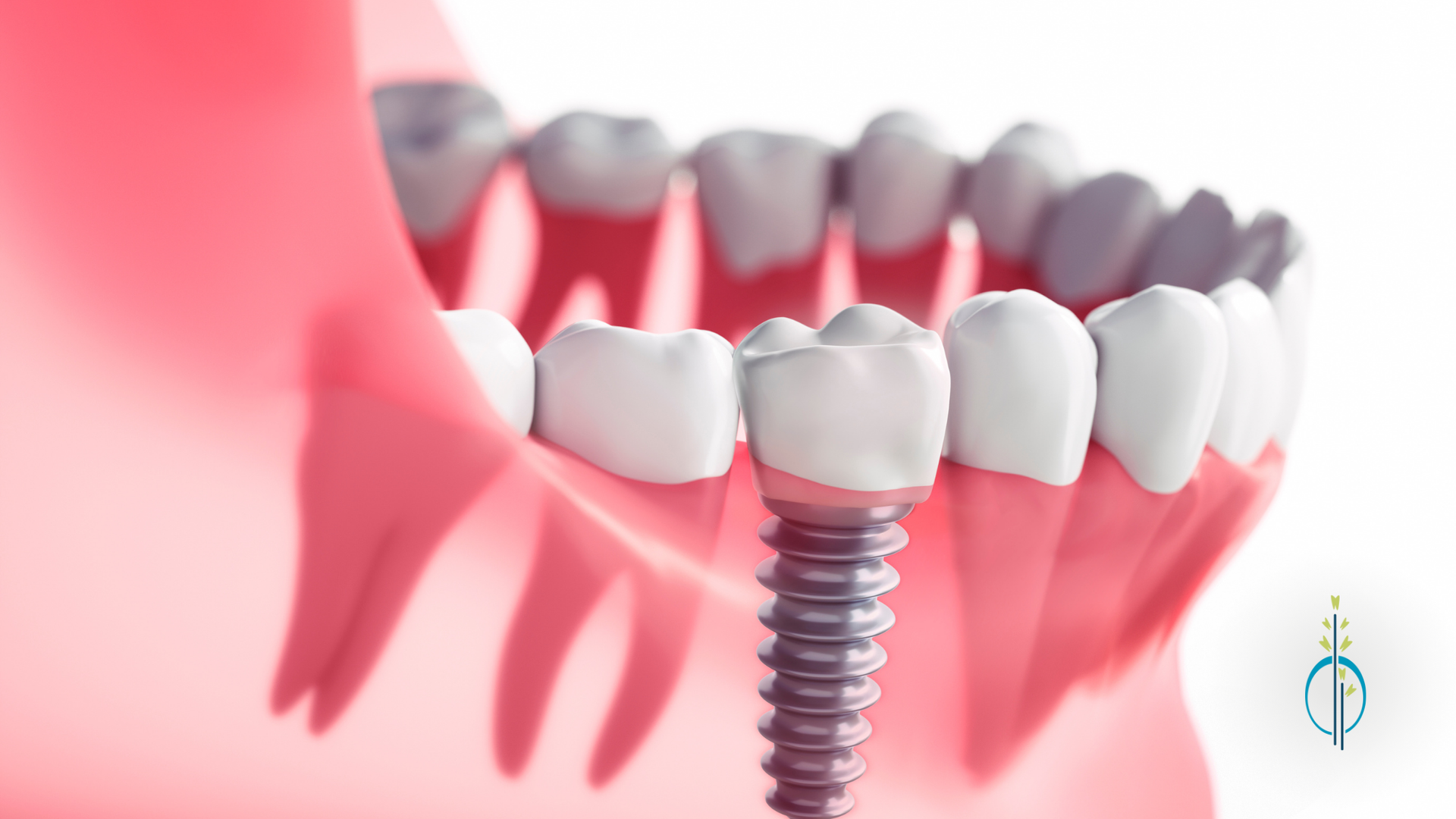 A close up of a dental implant in a person 's mouth.