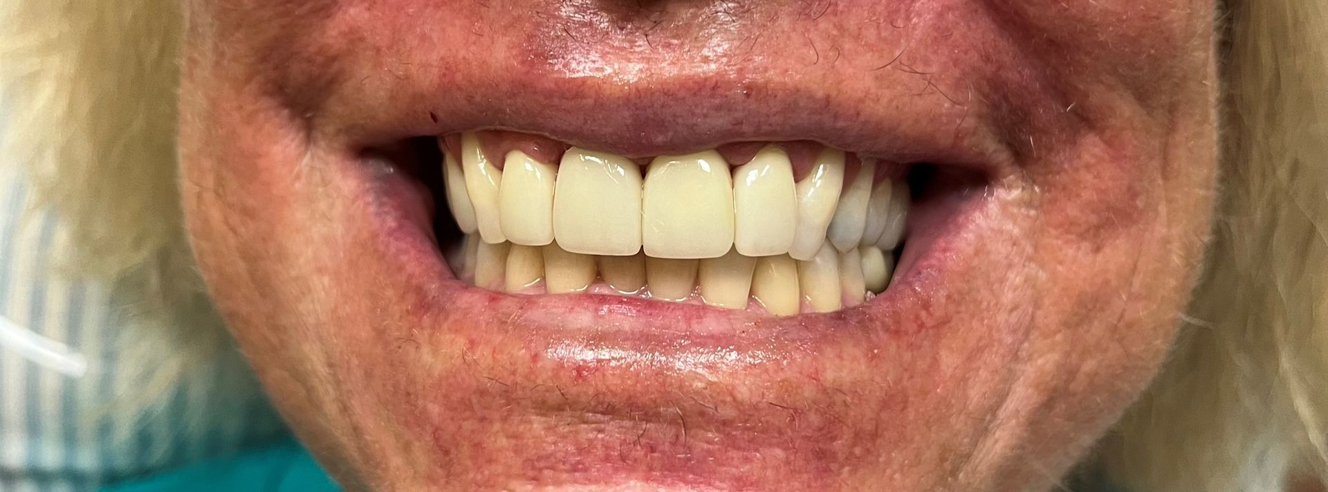 A close up of a woman 's teeth with a smile on her face.