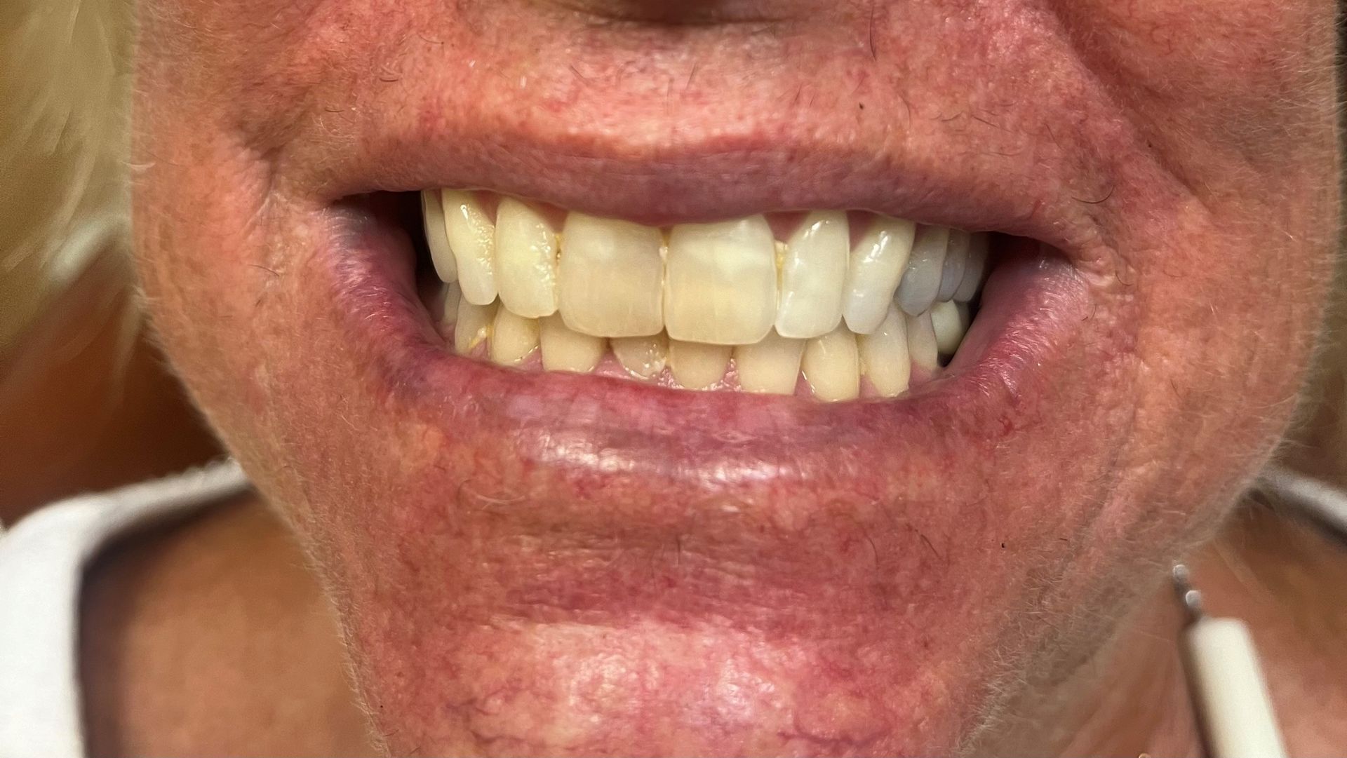 A close up of a woman 's mouth with white teeth.