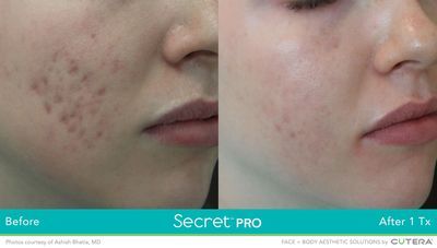 A before and after photo of a woman 's face with acne