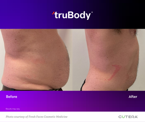 A before and after picture of a man 's stomach with the words trubody on the bottom